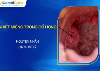 Nhiệt Miệng Trong Cổ Họng: Nguyên Nhân, Cách Xử Lý