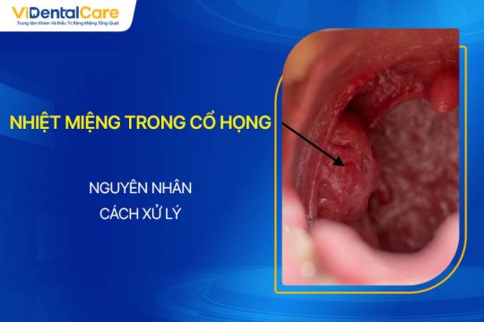 Nhiệt Miệng Trong Cổ Họng: Nguyên Nhân, Cách Xử Lý