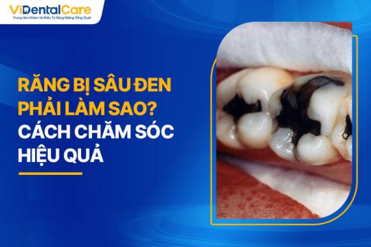 Răng Bị Sâu Đen Phải Làm Sao? Cách Chăm Sóc Hiệu Quả