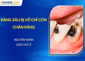 Răng Sâu Bị Vỡ Chỉ Còn Chân Răng Do Đâu? Xử Lý Thế Nào?