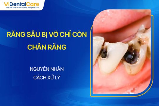 Răng Sâu Bị Vỡ Chỉ Còn Chân Răng Do Đâu? Xử Lý Thế Nào?