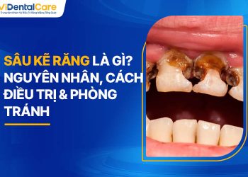 Sâu Kẽ Răng Là Gì? Nguyên Nhân, Cách Điều Trị & Phòng Tránh