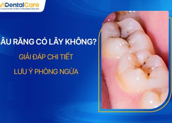 Sâu Răng Có Lây Không? Làm Thế Nào Để Phòng Ngừa?