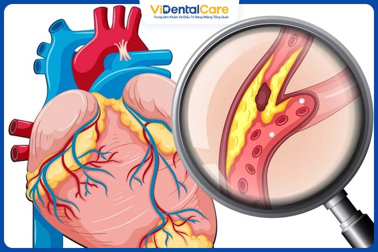 Người có bệnh tim mạch nếu nhổ răng sẽ khó cầm máu