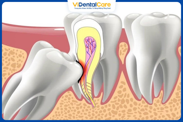 Răng khôn mọc lệch hoặc mọc sai vị trí nên được nhổ bỏ