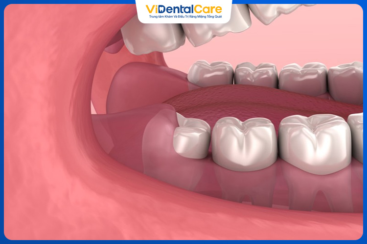 Việc chăm sóc răng miệng sẽ quyết định với thời gian lành thương