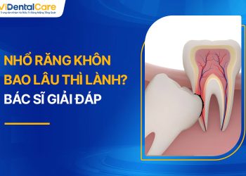 Nhổ Răng Khôn Bao Lâu Thì Lành? Bác Sĩ Giải Đáp