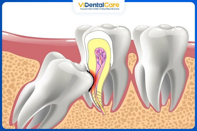 Nếu thực hiện đúng kỹ thuật sẽ không gây ảnh hưởng tới thần kinh