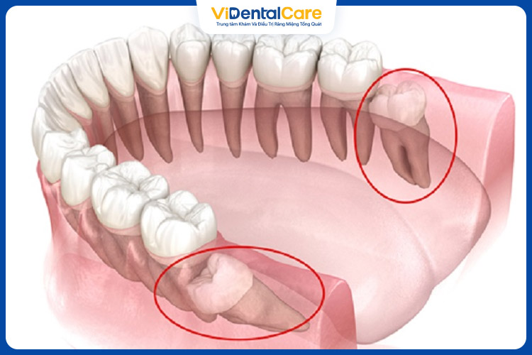 Chi phí nhổ răng mọc ngầm phụ thuộc vào nhiều yếu tố