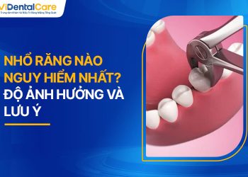 Nhổ Răng Nào Nguy Hiểm Nhất? Độ Ảnh Hưởng Và Lưu Ý