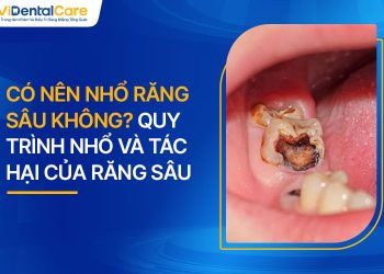 Có Nên Nhổ Răng Sâu Không? Quy Trình Nhổ Và Tác Hại Của Răng Sâu