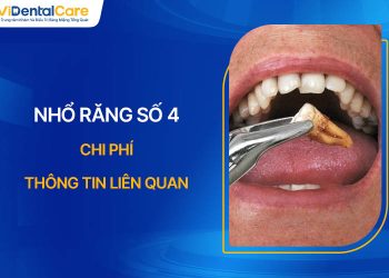 Có Nên Nhổ Răng Số 4? Chi Phí Và Thông Tin Liên Quan