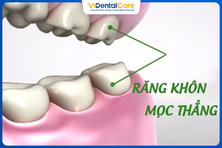 Răng khôn nếu không gây ảnh hưởng đến các răng khác sẽ không cần nhổ