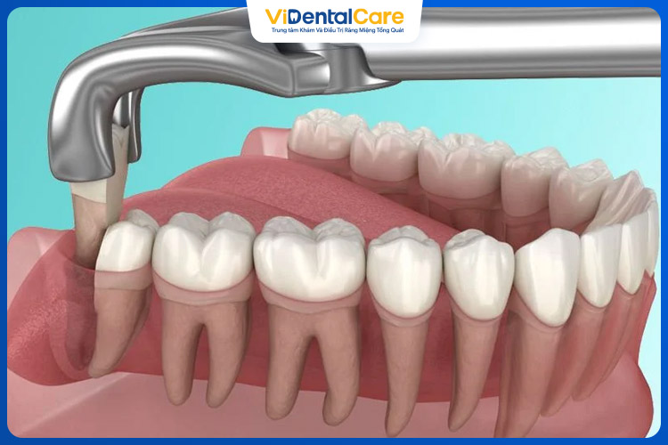 Sau khoảng 3 đến 4 ngày, bạn có thể dần dần quay trở lại chế độ ăn uống như trước