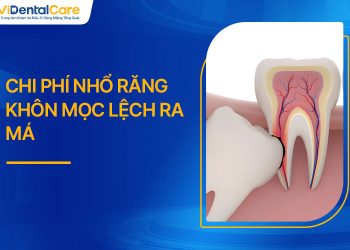 Chi Phí Nhổ Răng Khôn Mọc Lệch Ra Má Cập Nhất Mới Nhất