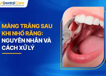 Màng Trắng Sau Khi Nhổ Răng: Nguyên Nhân Và Cách Xử Lý