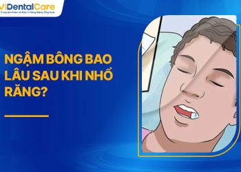 Ngậm Bông Bao Lâu Sau Khi Nhổ Răng? Hướng Dẫn Cách Thực Hiện