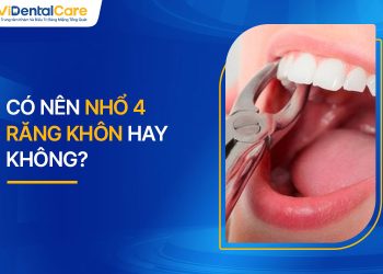 Có Nên Nhổ 4 Răng Khôn Hay Không? Kinh Nghiệm Bạn Nên Biết