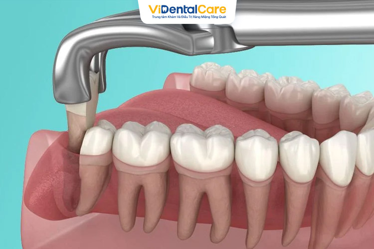 Mỗi giai đoạn sẽ có sự khác biệt về khả năng mọc lại sau khi nhổ răng.