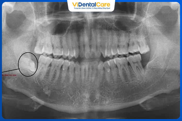 Nếu chân răng sau khi nhổ vẫn còn thiếu một phần, có thể chân răng đã bị sót lại.