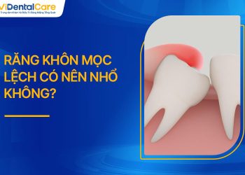 Răng Khôn Mọc Lệch Có Nên Nhổ Không? Giải Đáp Chi Tiết